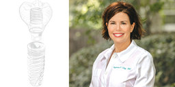 My First Glidewell HT™ Implant Stephenie Tilley image