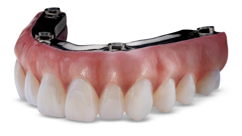 BruxZir Implant Prosthesis Descriptive Image