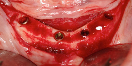 An edentulous mandible is restored using Glidewell HT Implants in an All-on-Four treatment configuration. thumbnail image