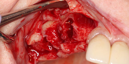 Glidewell HT Implants are used to treat an edentulous span in the maxillary arch. thumbnail image