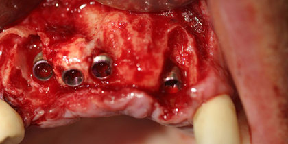 Glidewell HT Implants are immediately placed and provisionalized in an edentulous span of a patient’s anterior maxilla, contributing to a predictable final outcome. thumbnail image