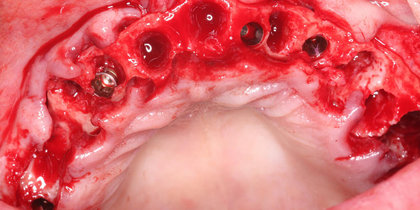 After extracting a patient’s non-restorable maxillary dentition, Glidewell HT Implants are inserted to retain an implant overdenture. thumbnail image
