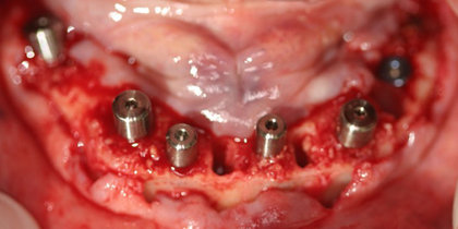 The terminal dentition of a mandibular arch is restored with seven Glidewell HT Implants and a full-arch monolithic zirconia prosthesis. thumbnail image