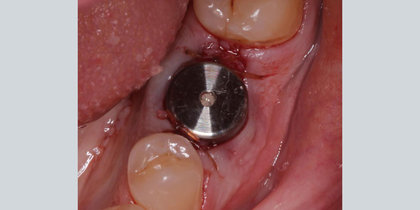 A Glidewell HT Implant is immediately placed following the extraction of tooth #19. thumbnail image