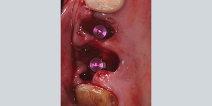 Glidewell HT Implants are immediately placed into extraction sites in the areas of tooth #3 & #4. thumbnail image