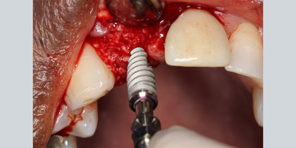 A Glidewell HT is immediately placed into the extraction socket of a maxillary central incisor. thumbnail image
