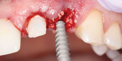 Tooth #10 is immediately replaced with a Glidewell HT Implant, leading to an esthetic final restoration. thumbnail image