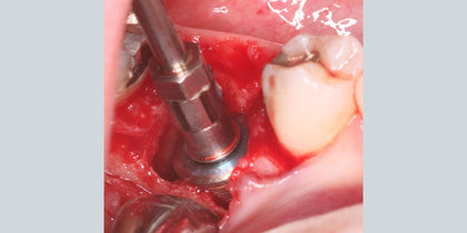 Tooth #30 is extracted and immediately replaced with a Glidewell HT Implant. thumbnail image