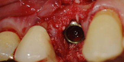 After extracting tooth #5, a Glidewell HT Implant is immediately placed and a provisional crown delivered, leading to an esthetic, predictable final restoration. thumbnail image