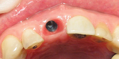 A central incisor is extracted and immediately replaced with a Glidewell HT Implant and provisional crown, facilitating an esthetic final outcome. thumbnail image