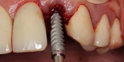A Glidewell HT Implant is immediately placed into an extraction socket to replace a grossly decayed tooth #10, establishing the stability needed for provisionalization and a predictable final restoration. thumbnail image