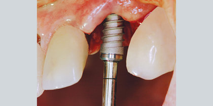 A large periapical defect necessitates precise angulation of a Glidewell HT Implant in the extraction site prior to temporization, establishing a stable foundation for the eventual restoration. thumbnail image