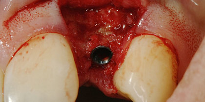 A 3.0-mm-diameter Glidewell HT Implant is used to restore the edentulous space resulting from a congenitally missing lateral maxillary incisor. thumbnail image