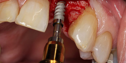 Tooth #10 is restored using a narrow-diameter Glidewell HT Implant. thumbnail image