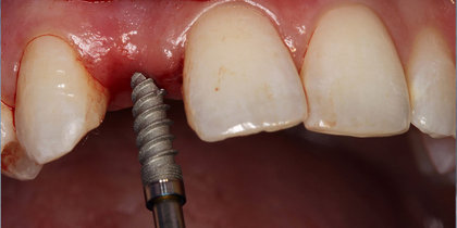 Tooth #7 is restored using a narrow-diameter Glidewell HT Implant. thumbnail image
