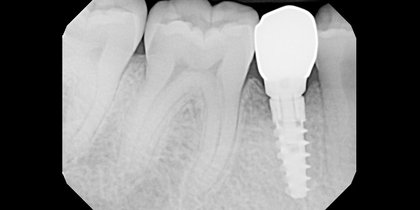 A narrow edentulous space in the area of tooth #29 is restored using a 3.5-mm-diameter Glidewell HT Implant. thumbnail image