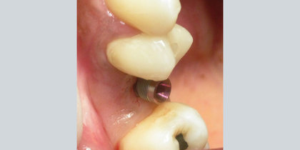 An edentulous space in the area of tooth #4 is restored with a Glidewell HT Implant. thumbnail image