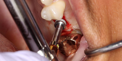 Tooth #14 is replaced using a Glidewell HT Implant. thumbnail image