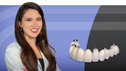 4 Ways to Provisionalize Dental Implants image