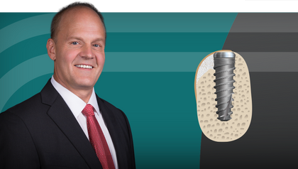 Guided Bone Regeneration: 8 Steps to Successful Ridge Augmentation image