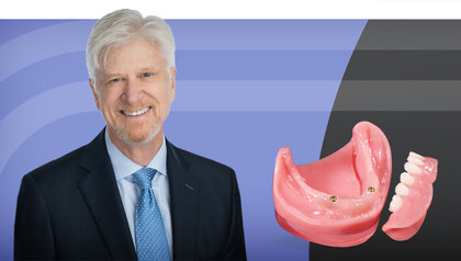 Restoration of Implant Overdentures image