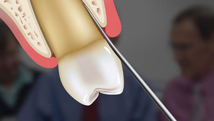 Extraction and Socket Grafting Online Course image