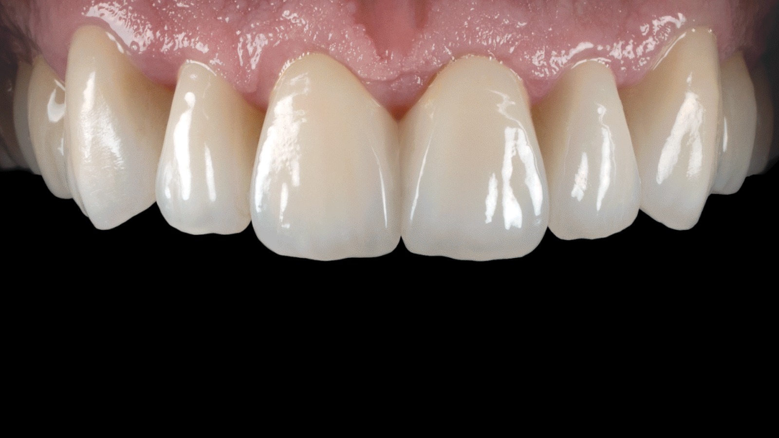 BruxZir® Glass - Product Image image
