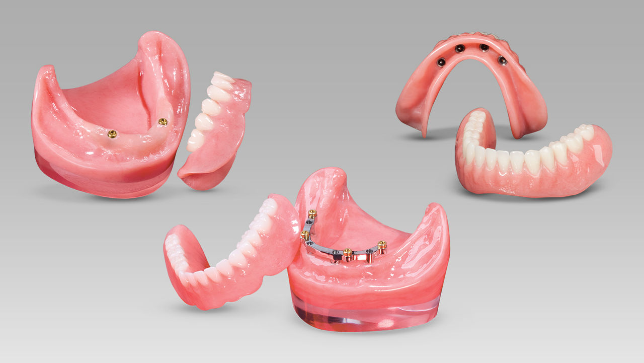 3 Types of Implant Overdentures: Which Patients Are the Best Candidates?