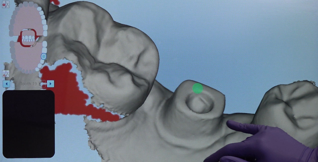 image of an implant scan showing the margins of the abutment