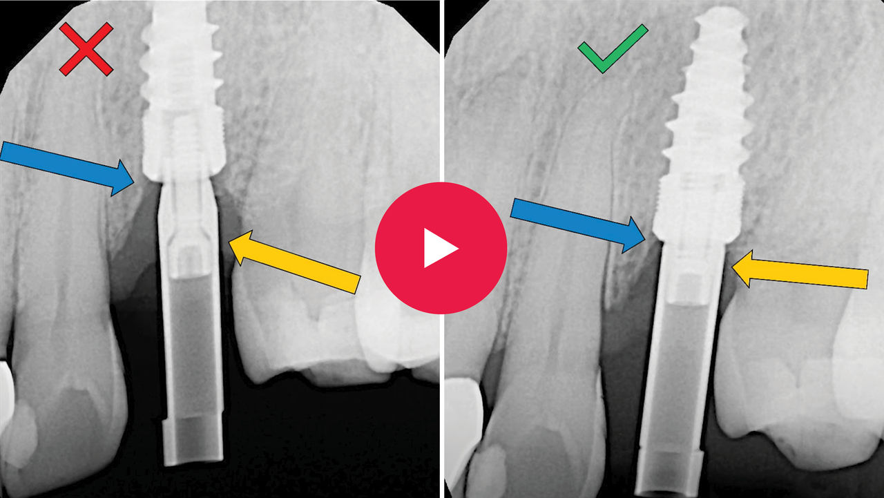 Understand How to Utilize an Implant Scan Body for an Accurate Digital Impression Video Image