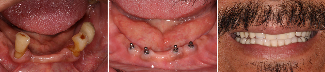 Four Inclusive Mini Implants were placed in the patient’s mandible
