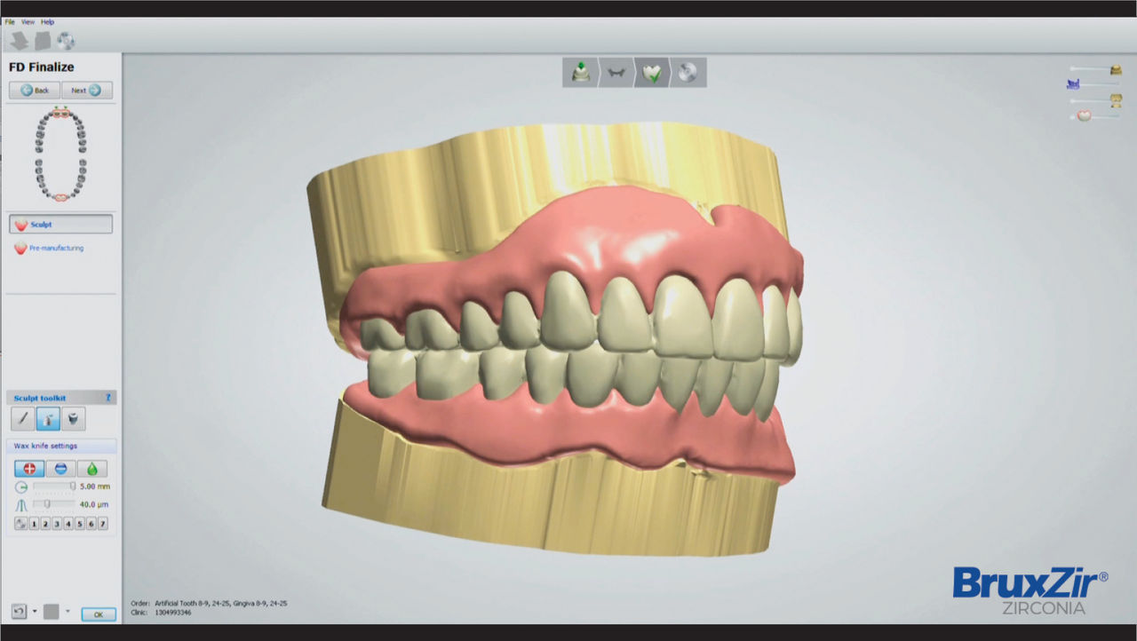 The Benefits of 3D-Printed Immediate Dentures