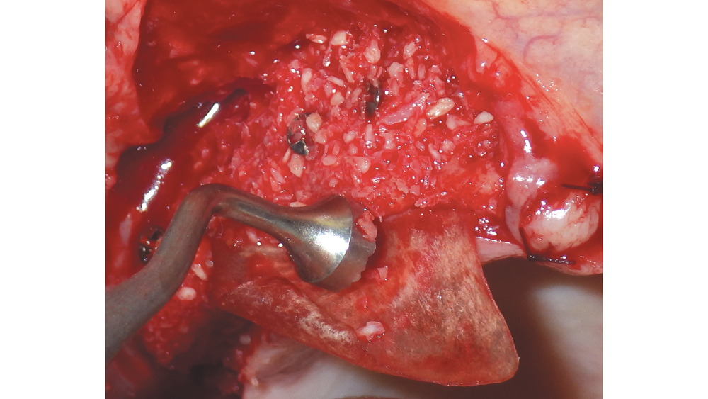 Shown is the lateral ridge augmentation procedure with the use of mineralized cortico/cancellous bone and osteotome