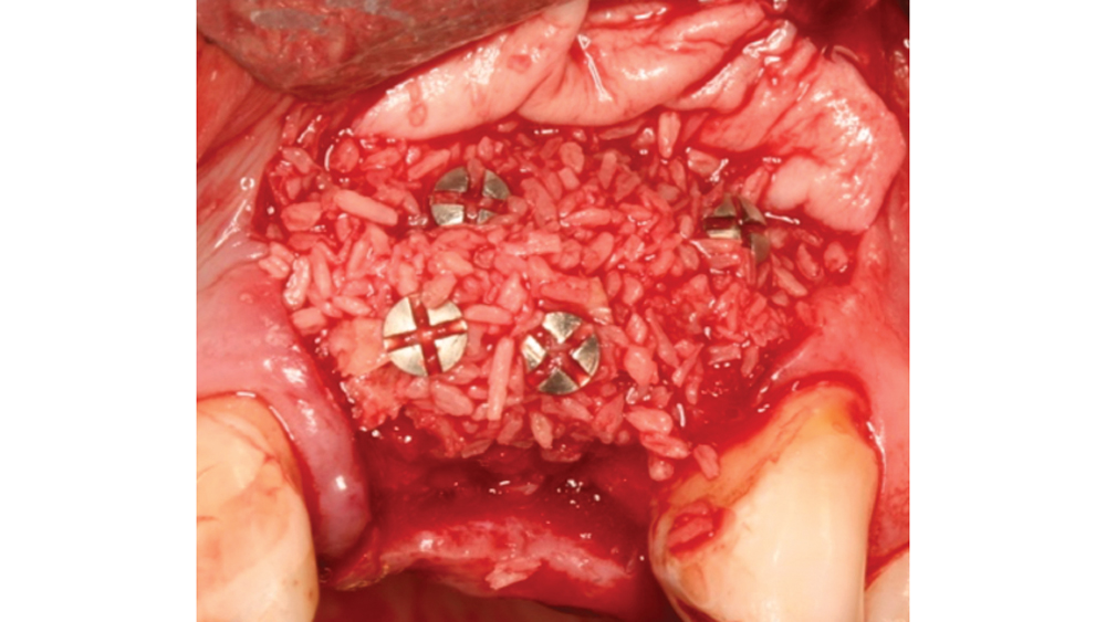 The cancellous bone allows for better cell migration and faster remodeling