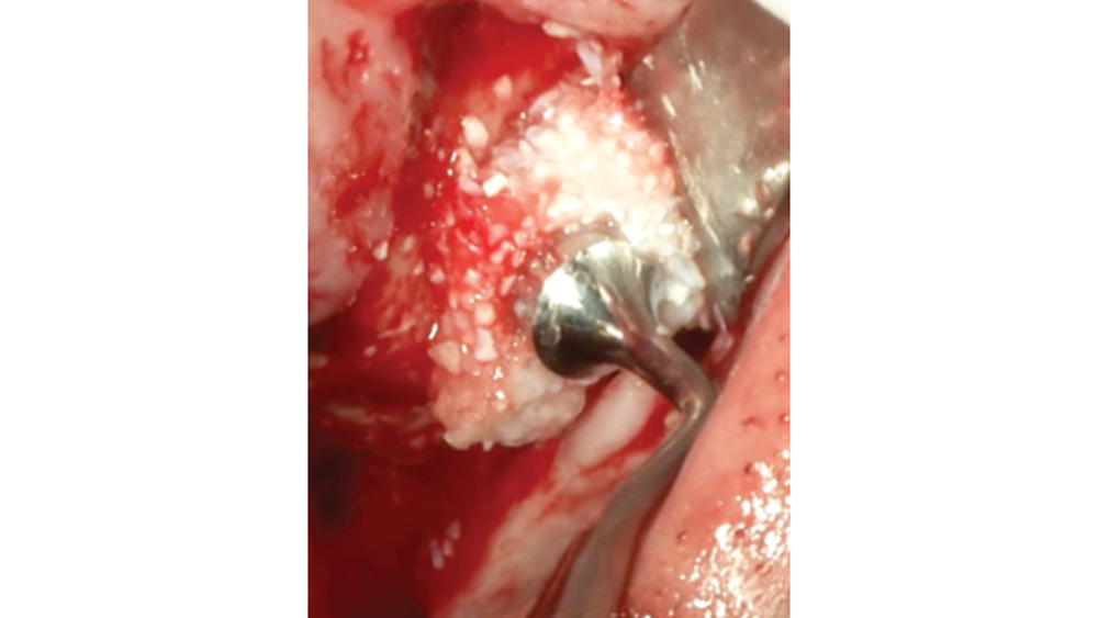 Bone graft putty is shown inserted into an osteotomy via osteotome sinus graft technique