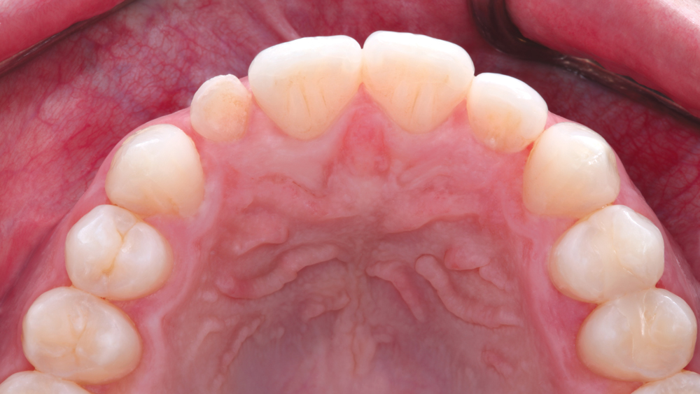 Close-up of the replaced maxillary lateral incisor