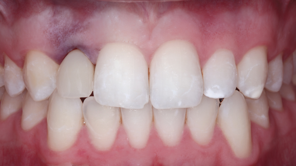 Patient's front teeth view