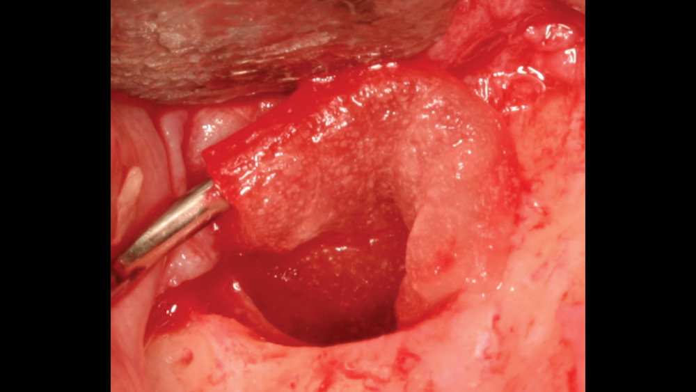 Figure 6b: hemostasis and small graft site close-up