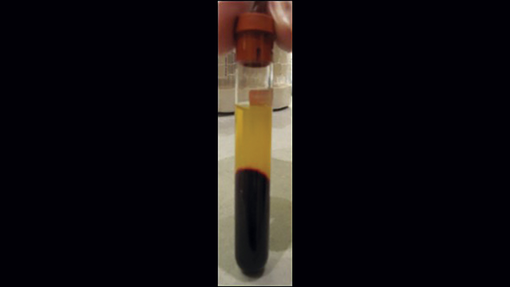 Figure 10a Platelet-rich fibrin