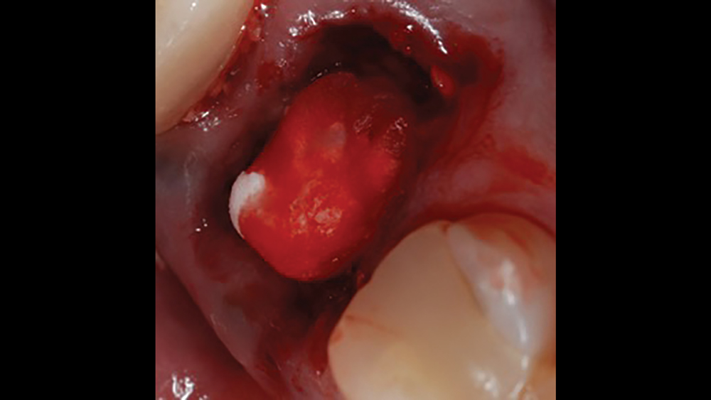 Figure 5b: The plug helps control bleeding and maintain the blood clot in the extraction site