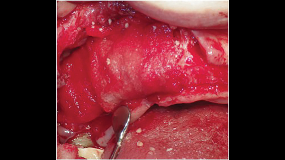 Figure 8b:  resorbable collagen membrane helps increase platelet aggregation and stability of clots, and allows for the attraction of fibroblasts for healing