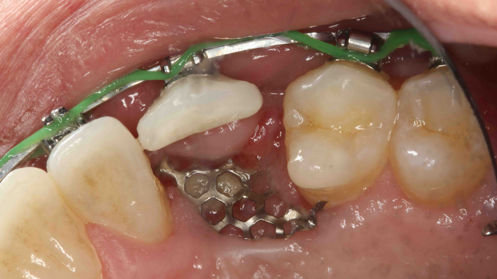 Figure 4b: Mesh exposure