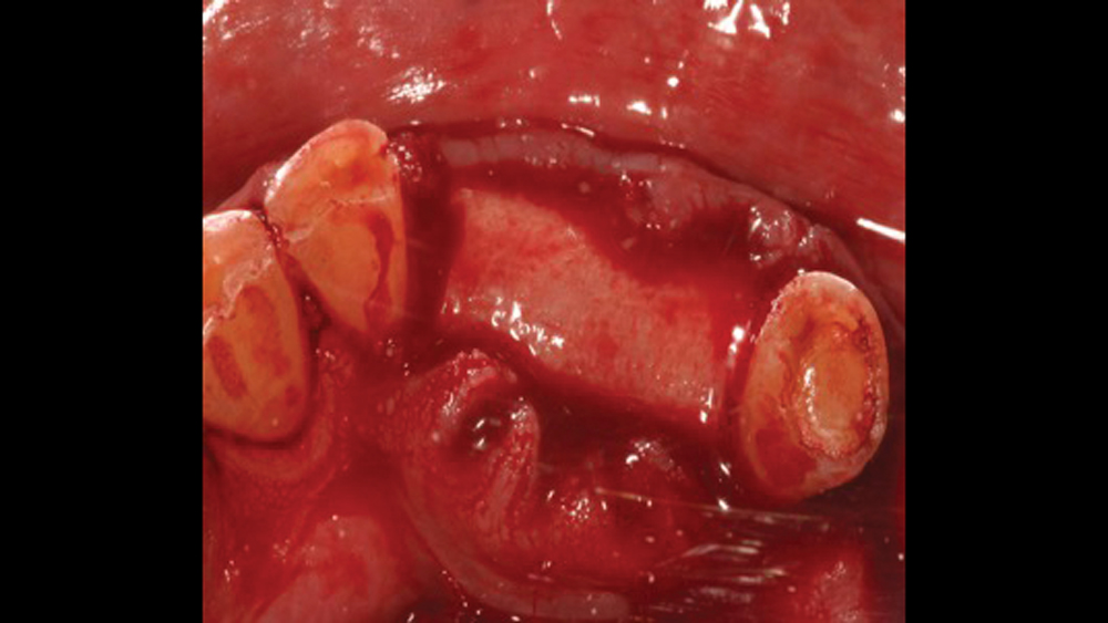 Figure 11b acellular dermal matrix is applied to site