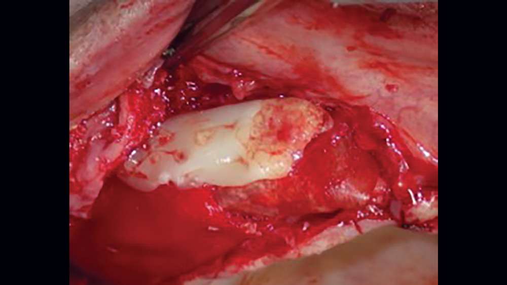 Figure 10d PRF membrane is placed