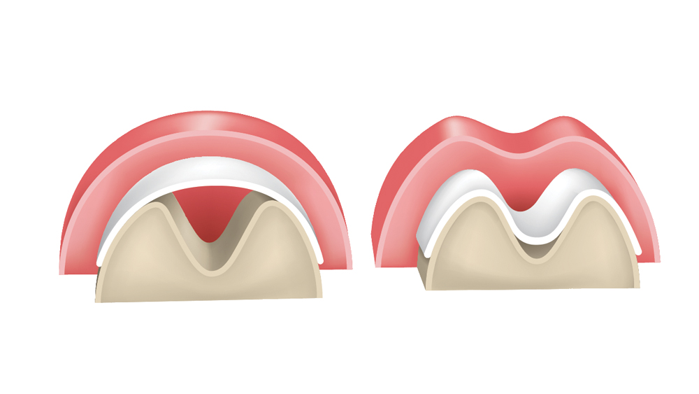 Figure 1 illustration: Membranes must exhibit space-maintenance qualities to allow bone regeneration to occur. If the membrane is not sufficiently stiff, there is potential for it to collapse within the defect, which results in altered bone growth