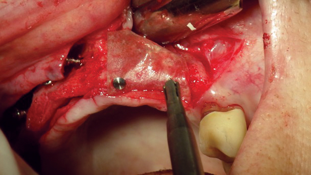 Pericardium membranes are typically derived from a bovine or porcine source