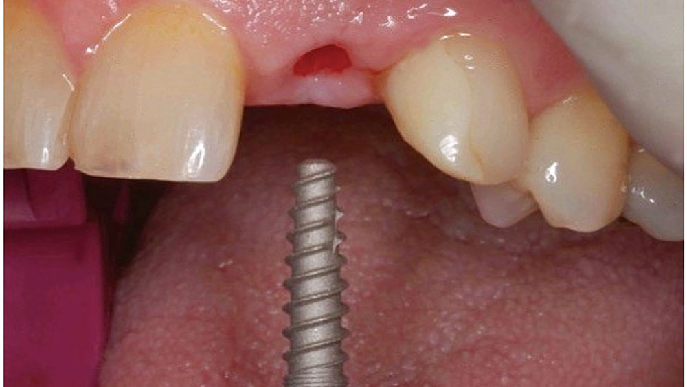 Hahn Tapered Implant being inserted