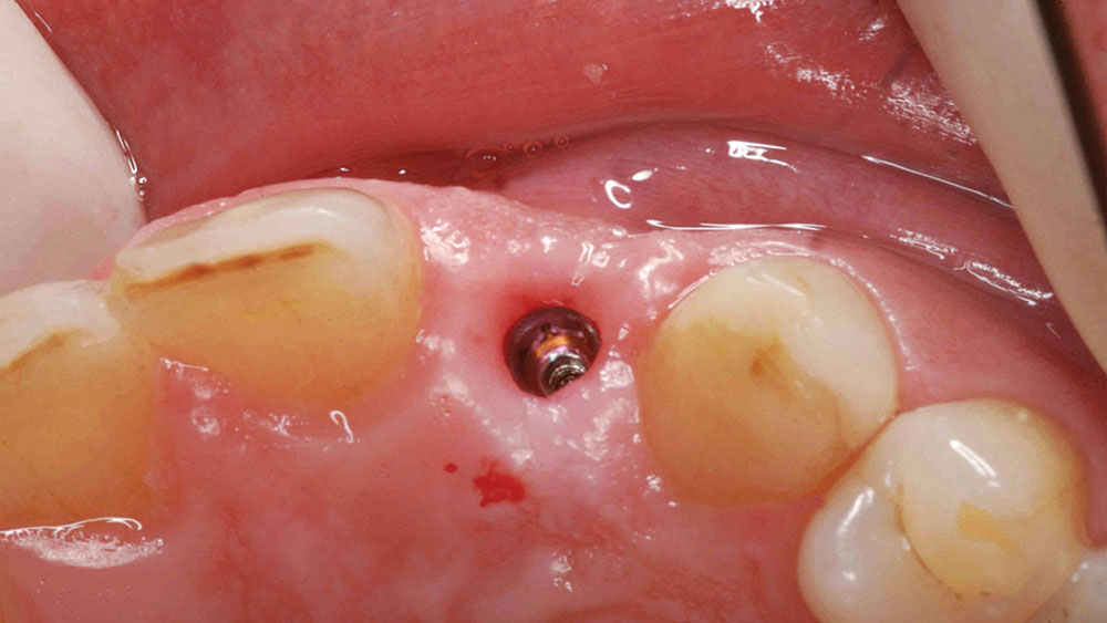 implant inserted with 2 mm of space between implant and the adjacent buccal, lingual, mesial and distal surfaces