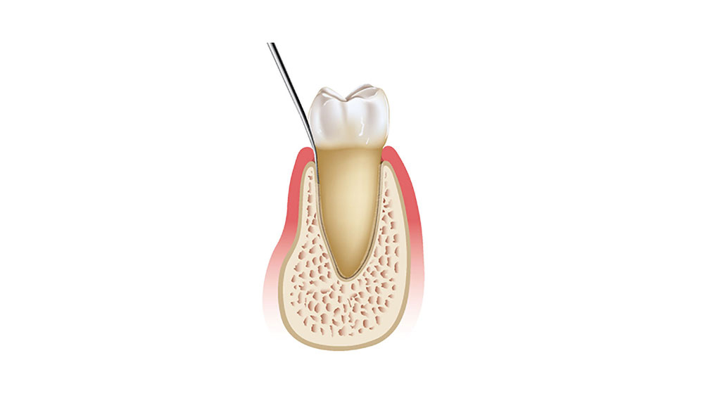 cm1401-atraumatic-extraction-01a