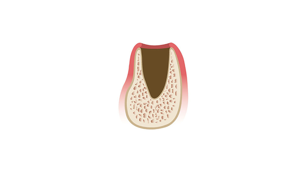 cm1401-atraumatic-extraction-01b